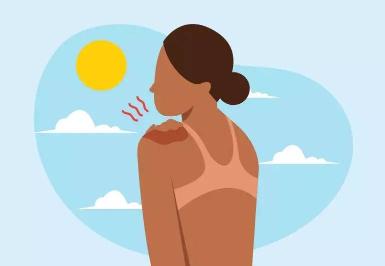 Find out how sunburn can lead to health risks